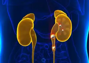 Calculs rénaux visibles dans l'appareil urinaire, illustrant les troubles urologiques liés aux calculs dans les reins et la vessie.